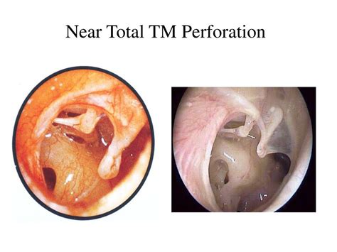 Ppt Chronic Otitis Media Com With And Without Cholesteatoma