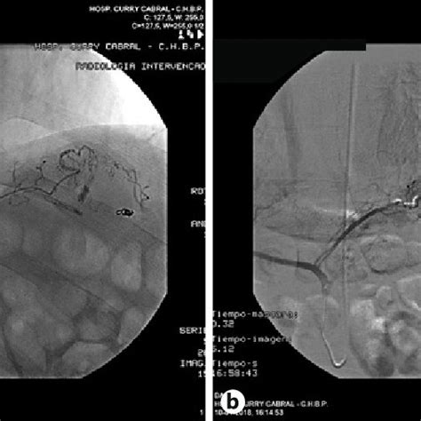 A Selective Left Gastric Artery Angiogram With Identification Of