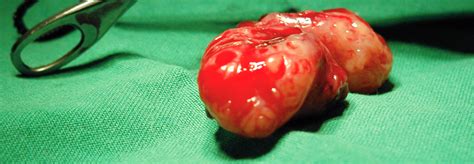 Daher ist eine sichere erkennung und zügige sanierung von trägern wichtig. MRSA: Persistierende Erreger mittels Tonsillektomie ...