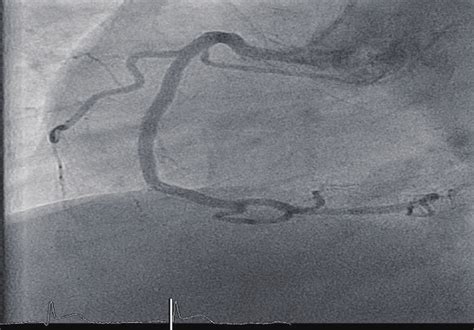 Coronary Angiography Lao 52caudal 15 View Showing Normal Rca Lao