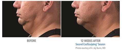 Coolsculpting Chin Before And After Pictures Bella Medspa