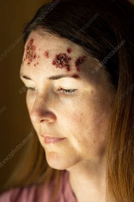 Basal Cell Carcinoma On A Patient S Forehead Stock Image C Science Photo Library