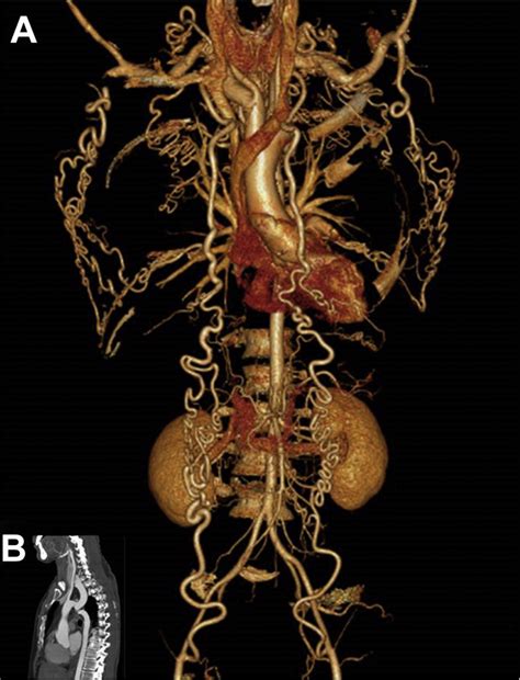 Coarctation Of The Aorta And The Nature Of Collateral Circulation
