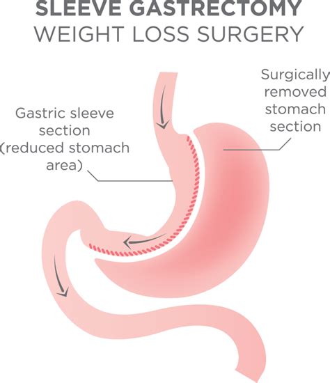 How To Choose The Best Gastric Sleeve Surgeon