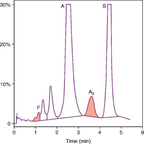 Hemoglobinopathies Structural Defects In Hemoglobin Rodak S