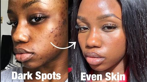 How To Get Rid Of Dark Spots Hyperpigmentation Fast On Black Skin