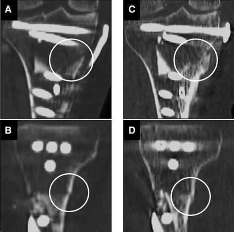 Postoperative Ct Imaging Of The Dome Osteotomy Site A Coronal