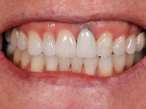Are Titanium Dental Implants Safe Metal Allergies Dental Implants