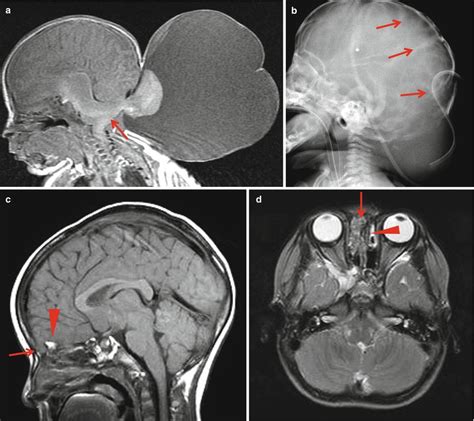 Congenital Anomalies Of The Brain And Spinal Cord Radiology Key My