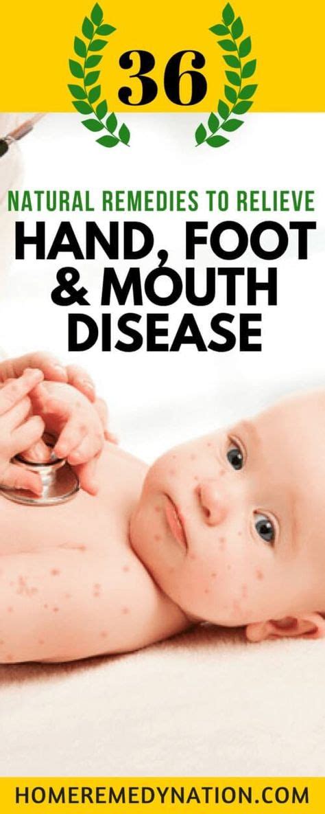 36 Home Remedies For Hand Foot And Mouth Disease In Adults And