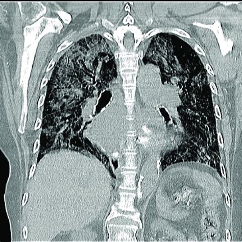 High Resolution Computed Tomography Chest Showing Diffuse Interstitial