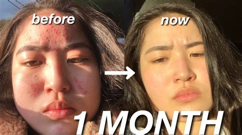 How I Cleared My Skin In A Month Skincare Routine Acne Journey