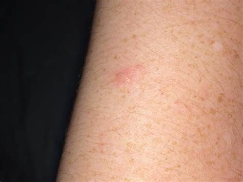 Images Of Bed Bug Bites On Arm Bed Bug Bites Typically Have A Small
