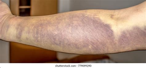Hematoma Images Stock Photos And Vectors Shutterstock