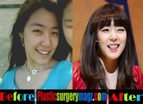 Tiffany Snsd Plastic Surgery Before And After