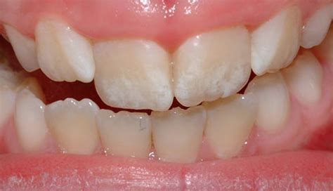 White Spots On Teeth Meaning Causes And Types Dr Stephen Spelman My