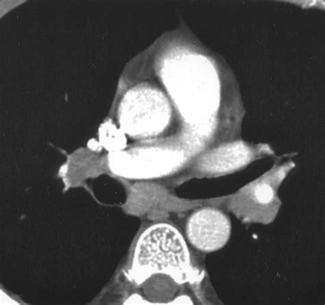 Sonographically Guided Biopsy Of Supraclavicular Lymph Nodes A Simple