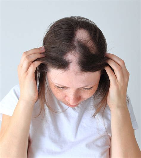 Top Genetic Hair Loss Symptoms Super Hot In Eteachers