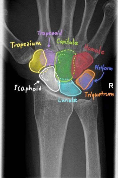Wrist Xray Anatomy Radiology Medical Anatomy Medical School Motivation