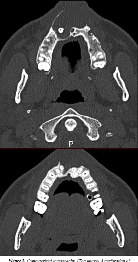 Figure 2 From Maxillary Dentigerous Cyst And Supernumerary Tooth Is It