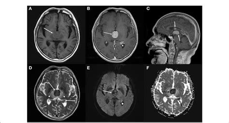 Figure E Brain Magnetic Resonance Imaging Mri A C Axial