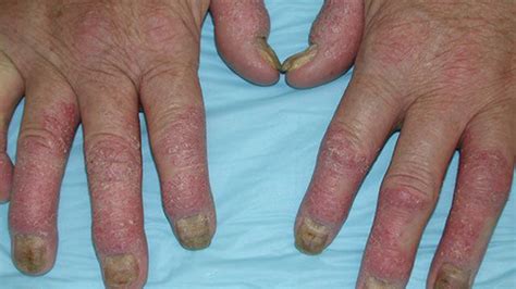 Psoriatic Arthritis Rash Symptoms Treatment And More