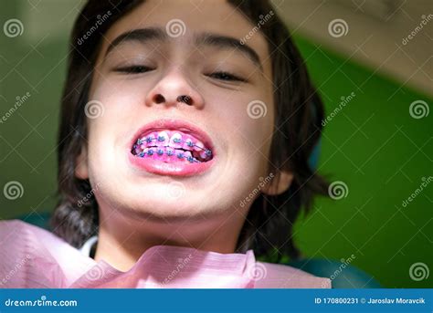 Kid With Dental Braces And Plaque Detection On Teeth Stock Image