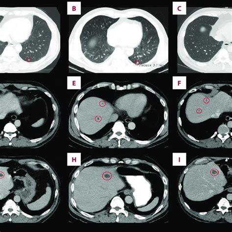 Thoracic And Abdominal Contrast Enhanced Computed Tomography Ct Scans