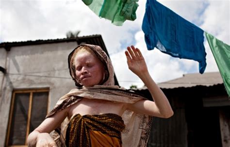 Cegah Pembunuhan Albino Tanzania Larang Praktik Perdukunan