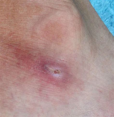 What Causes Red Spots On The Feet Other Symptoms And Treatment 2022