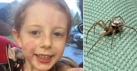 Girl 5 Covered In Rashes And Unable To Walk After Spider Bite Uk