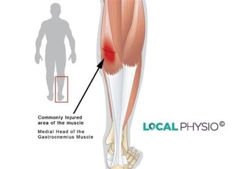 Calf Causes And Treatments Local Physio