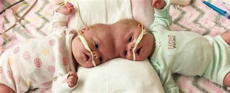 Conjoined Twins Have Survived One Of The Worlds Rarest Surgeries