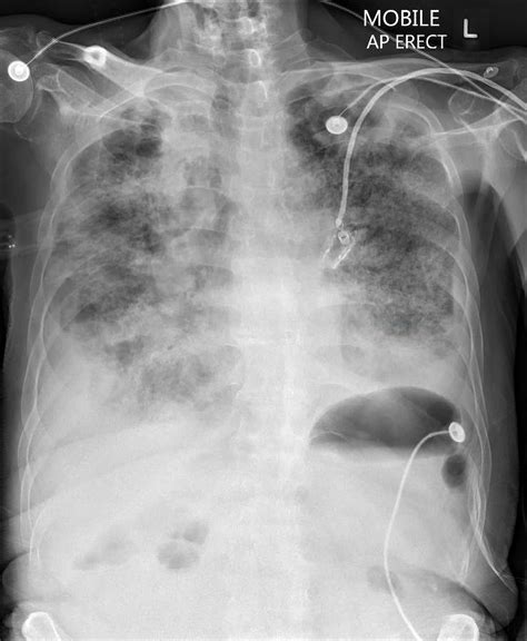 Pulmonary Nodules And Masses Chest X Ray Medbabe
