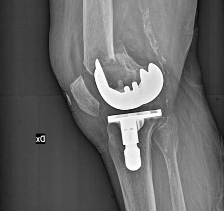 Pdf Periprosthetic Tibial Fractures In Total Knee Arthroplasty An My XXX Hot Girl