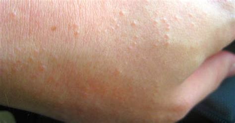 Heat Rash Bumps