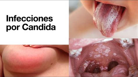 infecciones por candida candidiasis vulvovaginitis balanitis mastitis candidemia youtube