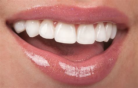 5 Things Everyone Should Know About Veneers Vernon Dentist Dr Gary