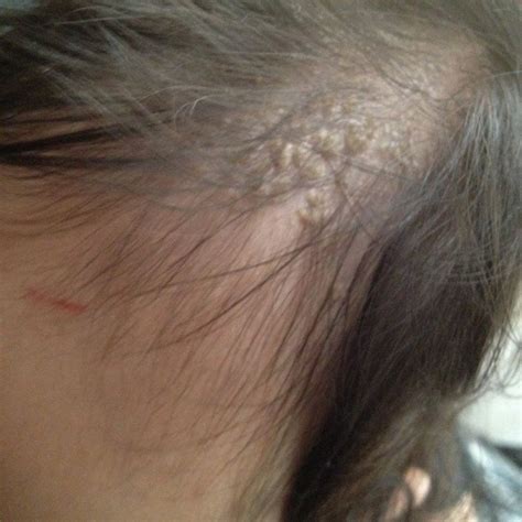 Baby Blue*** : 脂漏性湿疹