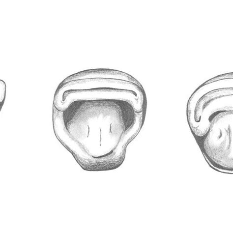 3 Occlusal View Of Morphological Variation In Shovel Shaped Incisors