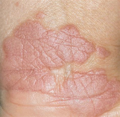 Lichen Planus Skin Disease
