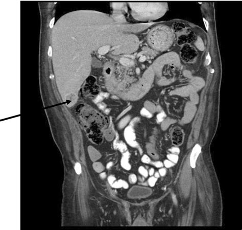 Seven Months After Presentation A Follow Up Ct Scan Showed A Hepatic
