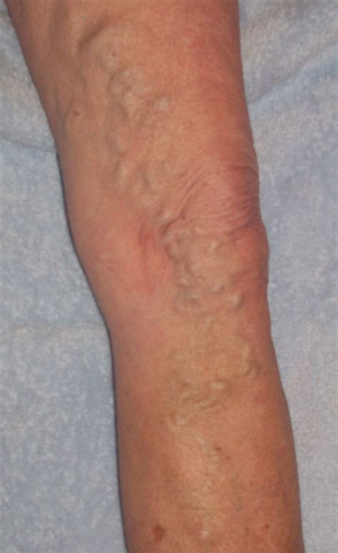 Varicose Veins From The Anterior Thigh To The Shin Varicose Veins