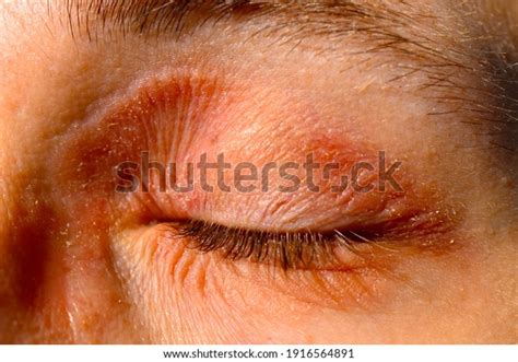 Atopic Eczema Around Eye Stock Photo Edit Now 1916564891