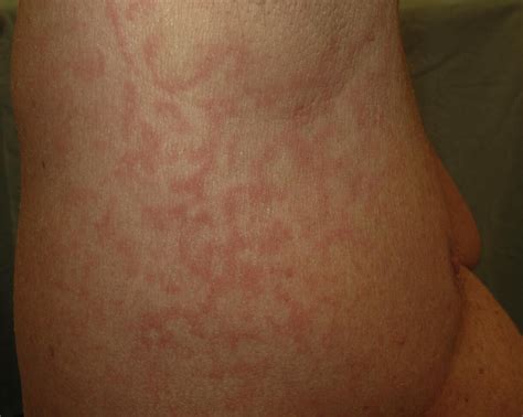 Pityriasis Rubra Pilaris Treated With Methotrexate Resolving With An