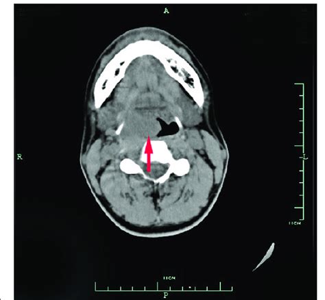 Ct Scan Showing A 30 Cm Mass Of The Parapharyngeal Space In Case 2