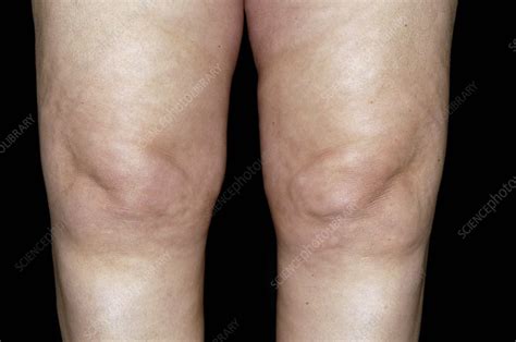 Osteoarthritis Of The Knees Stock Image C0051888 Science Photo Library