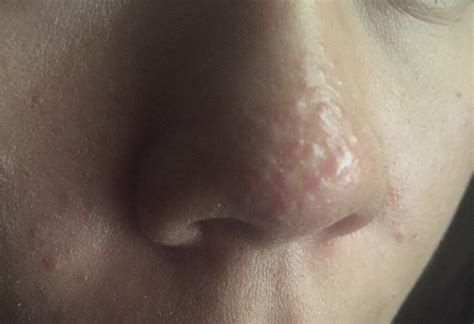 Nose Scars Acne Or Rosacea General Acne Discussion Forum