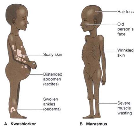 Your pet will begin to lose fur in patches and if the fur grows back, the fur will be a darker color. Protein-energy malnutrition