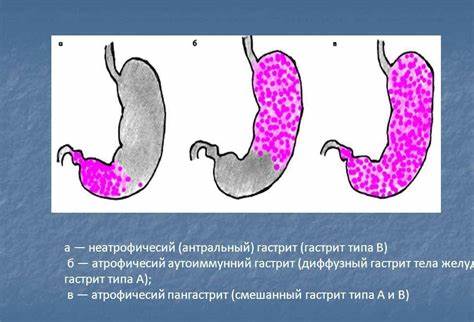 Антральный гастрит диета меню Антральный Гастрит Лечение Диета — Похудение Диета Правильное Питание Антральный Гастрит Лечение Диета — Похудение Диета Правильное Питание Антральный гастрит диета меню